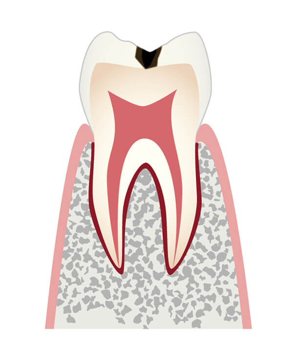 エナメル質＝歯の表面のむし歯