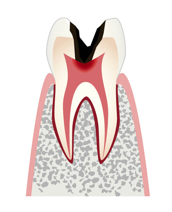 歯髄＝歯の神経まで達したむし歯